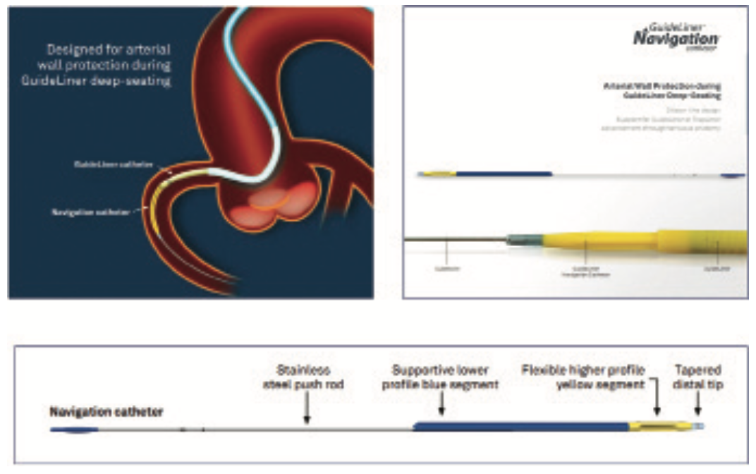 Guide Catheter Extension for Complex Percutaneous Coronary